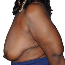 Breast Lift Before & After Patient #538