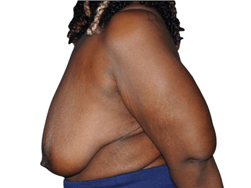 Breast Lift Before & After Patient #538