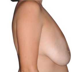 Breast Lift Before & After Patient #565