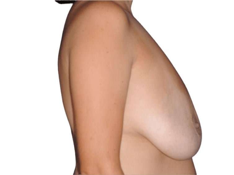 Breast Lift Before & After Patient #565