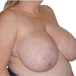 Breast Reduction Before & After Patient #579