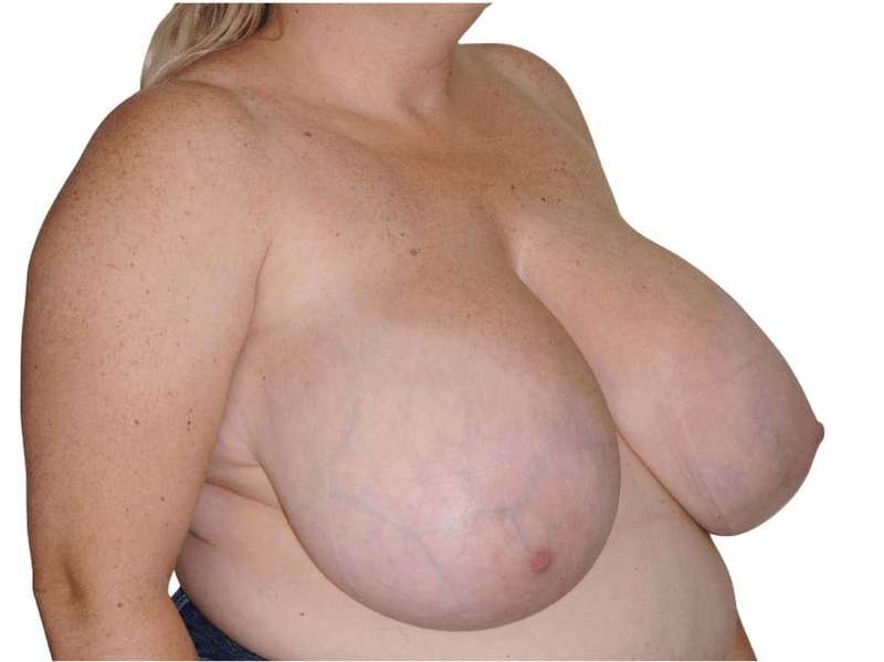 Breast Reduction Before & After Patient #579