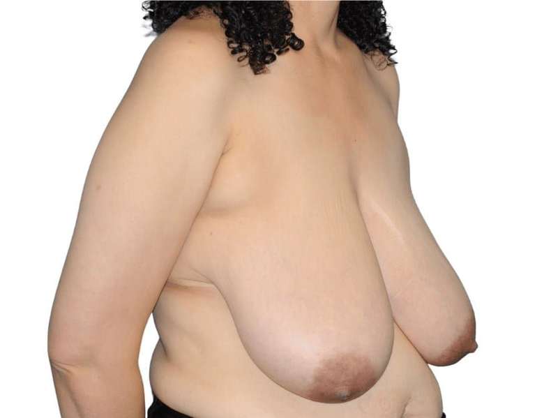 Breast Reduction Before & After Patient #601