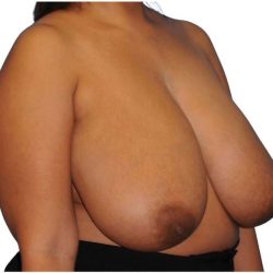 Breast Reduction Before & After Patient #617