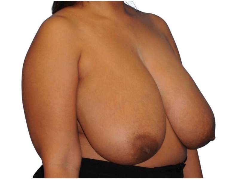 Breast Reduction Before & After Patient #617