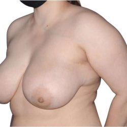 Breast Reduction Before & After Patient #624