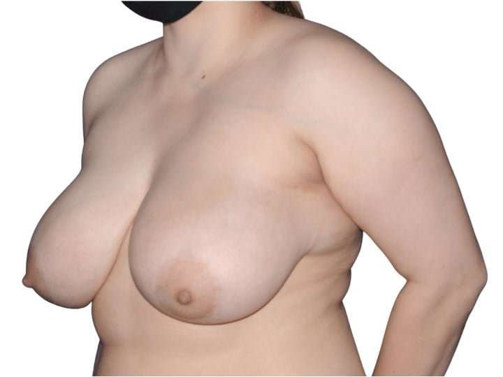 Breast Reduction Before & After Patient #624