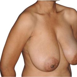 Breast Reduction Before & After Patient #630