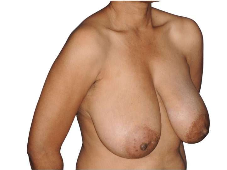 Breast Reduction Before & After Patient #630