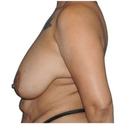 Breast Reduction Before & After Patient #635