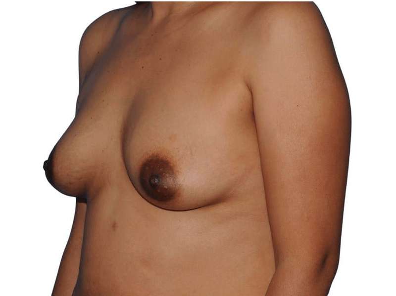 Breast Augmentation Before & After Patient #663