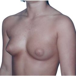 Breast Augmentation Before & After Patient #670