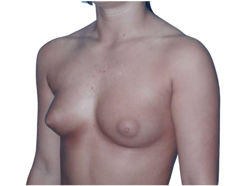 Breast Augmentation Before & After Patient #670