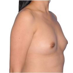 Breast Augmentation Before & After Patient #679