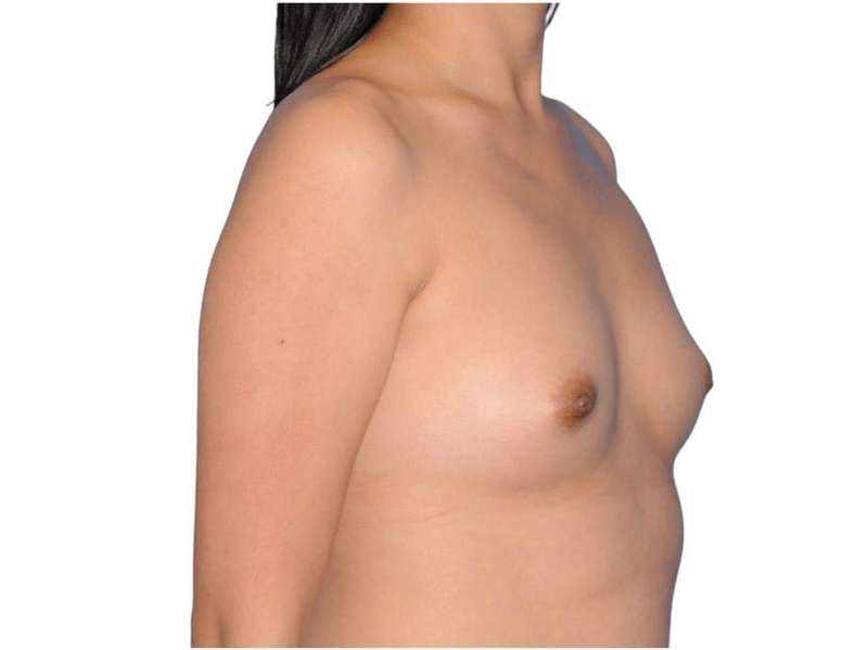 Breast Augmentation Before & After Patient #679
