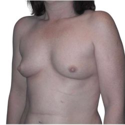 Breast Augmentation Before & After Patient #686