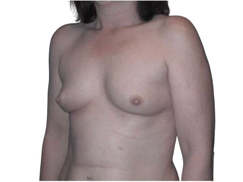 Breast Augmentation Before & After Patient #686