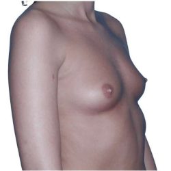 Breast Augmentation Before & After Patient #693