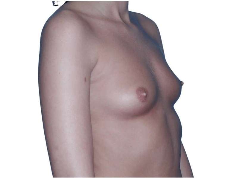 Breast Augmentation Before & After Patient #693
