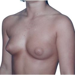 Breast Augmentation Before & After Patient #700