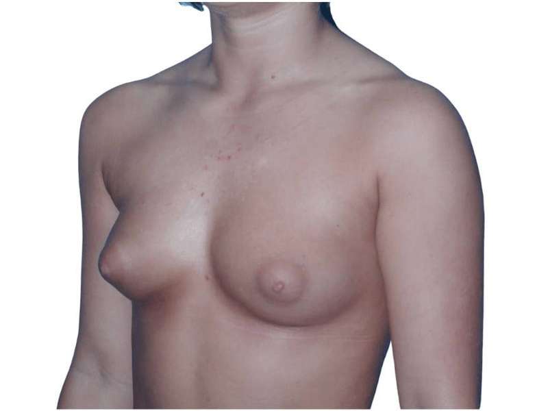 Breast Augmentation Before & After Patient #700