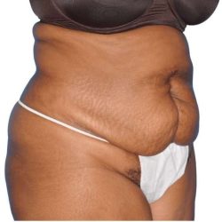 Tummy Tuck Before & After Patient #454