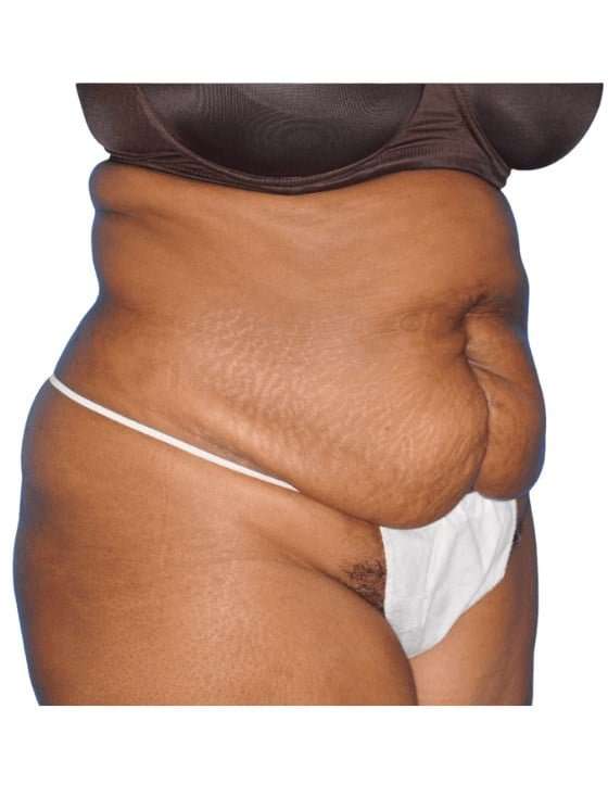 Tummy Tuck Before & After Patient #454