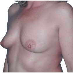 Breast Augmentation Before & After Patient #714