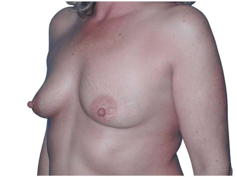Breast Augmentation Before & After Patient #714