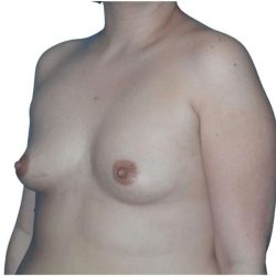 Breast Augmentation Before & After Patient #721