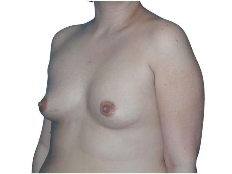 Breast Augmentation Before & After Patient #721