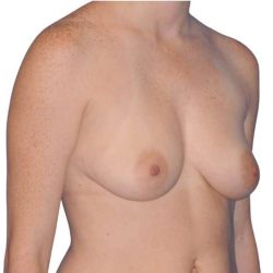 Breast Augmentation Before & After Patient #733