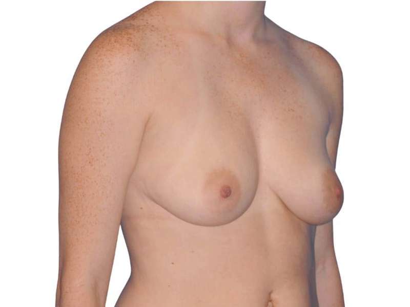 Breast Augmentation Before & After Patient #733