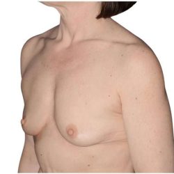 Breast Augmentation Before & After Patient #740