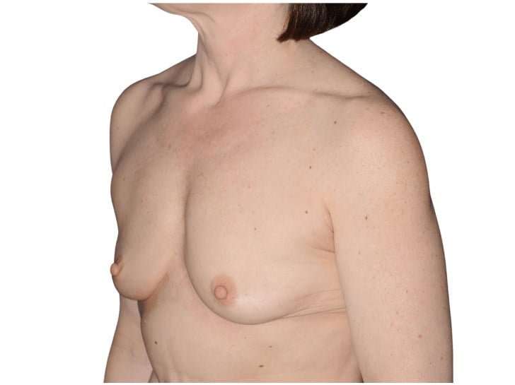 Breast Augmentation Before & After Patient #740