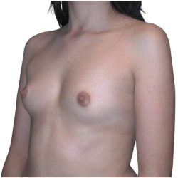 Breast Augmentation Before & After Patient #754