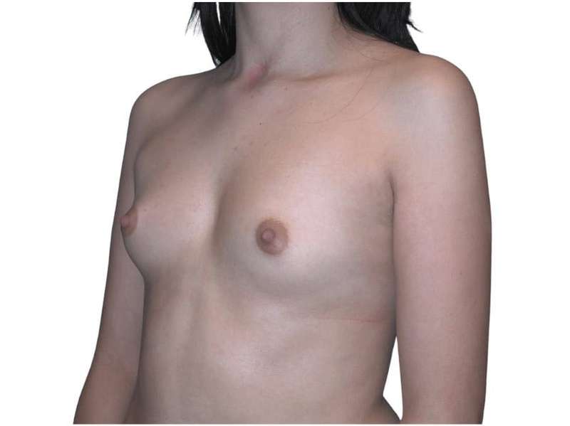 Breast Augmentation Before & After Patient #754