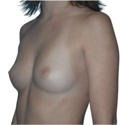 Breast Augmentation Before & After Patient #761