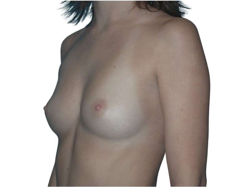 Breast Augmentation Before & After Patient #761