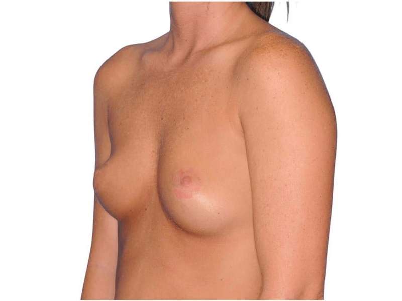 Breast Augmentation Before & After Patient #768