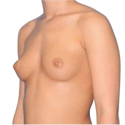 Breast Augmentation Before & After Patient #775