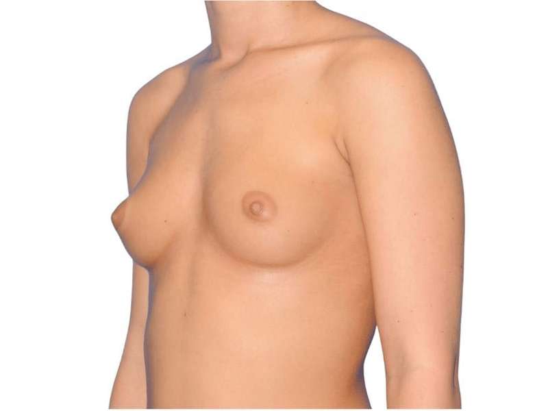 Breast Augmentation Before & After Patient #775