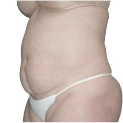 Tummy Tuck Before & After Patient #459