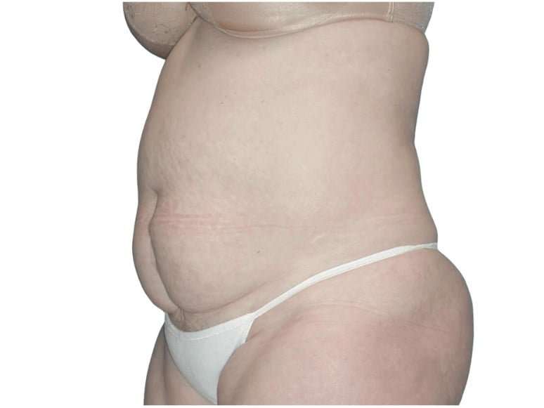Tummy Tuck Before & After Patient #459
