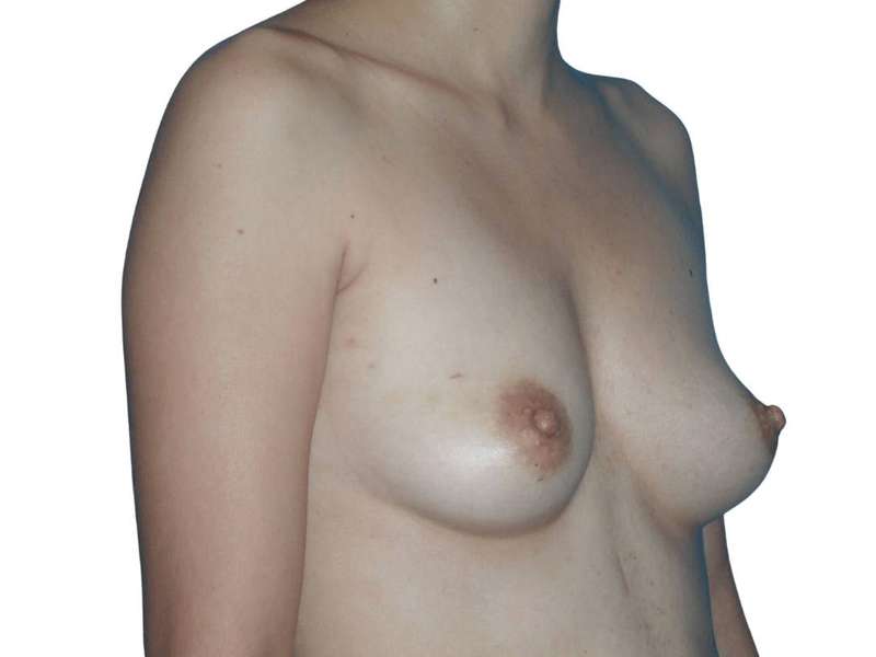Breast Reconstruction Before & After Patient #782