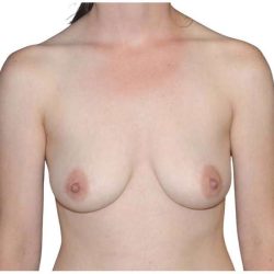 Breast Reconstruction Before & After Patient #794