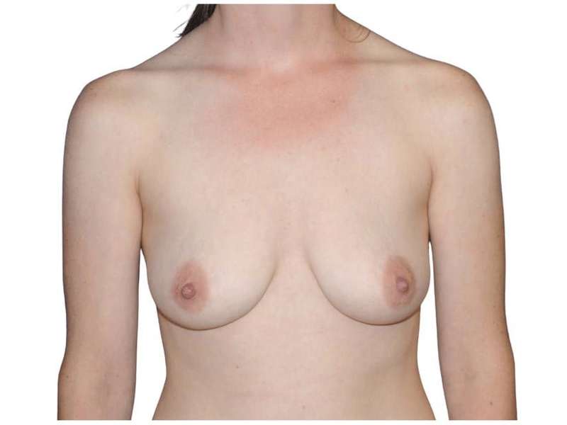 Breast Reconstruction Before & After Patient #794