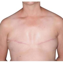 Breast Reconstruction Before & After Patient #805