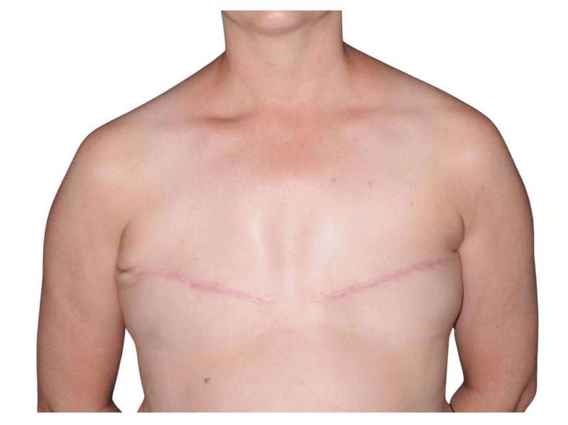 Breast Reconstruction Before & After Patient #805