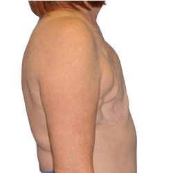 Breast Reconstruction Before & After Patient #810